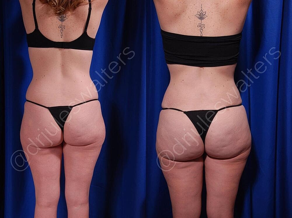 Body Contouring Before & After