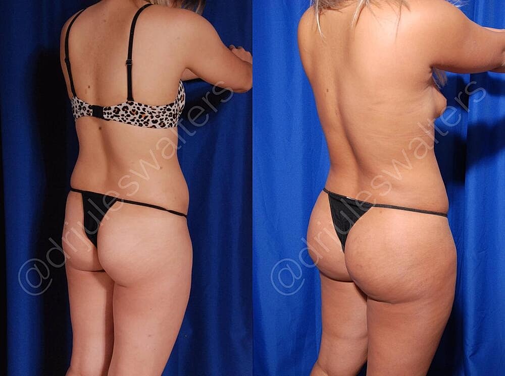 Body Contouring Before & After