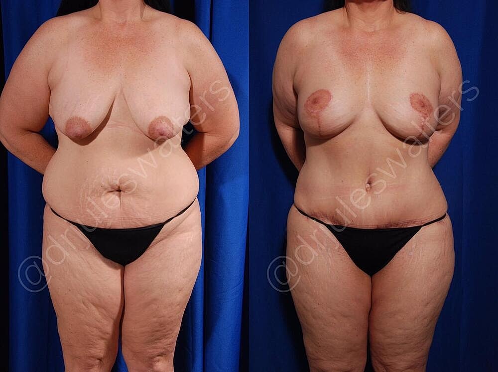 Body Contouring Before & After