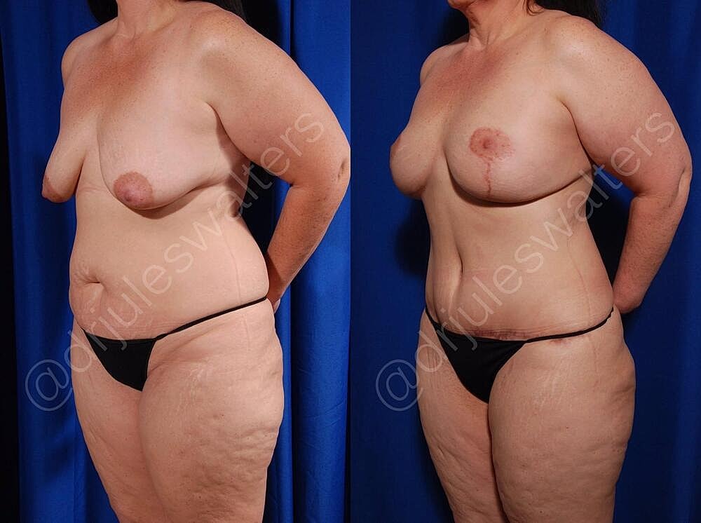 Body Contouring Before & After
