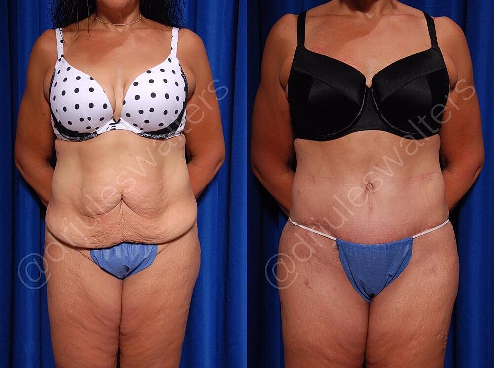 Body Contouring Before & After