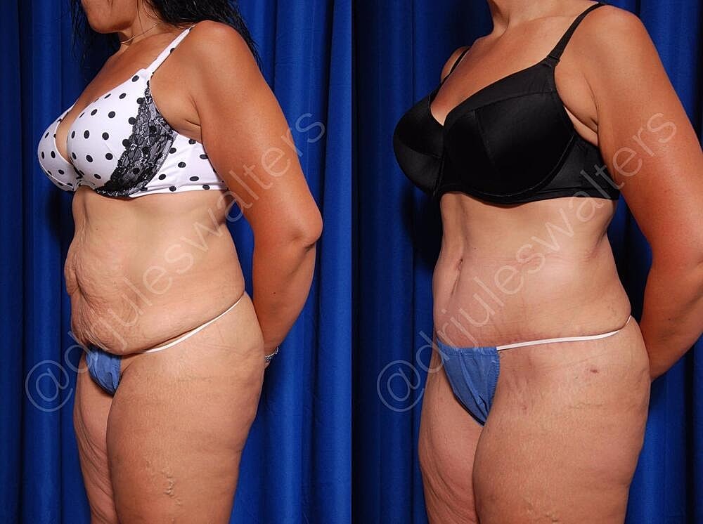 Body Contouring Before & After