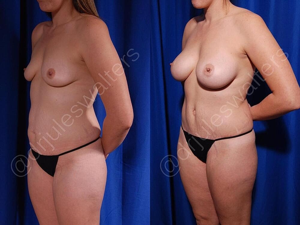 Body Contouring Before & After