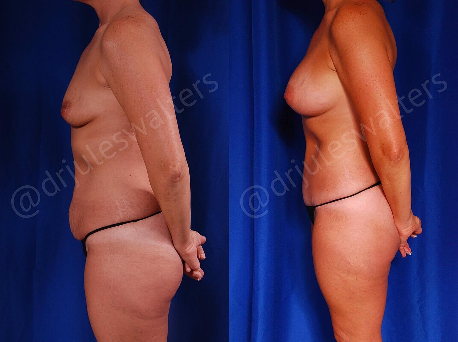 Mommy Makeover Before & After