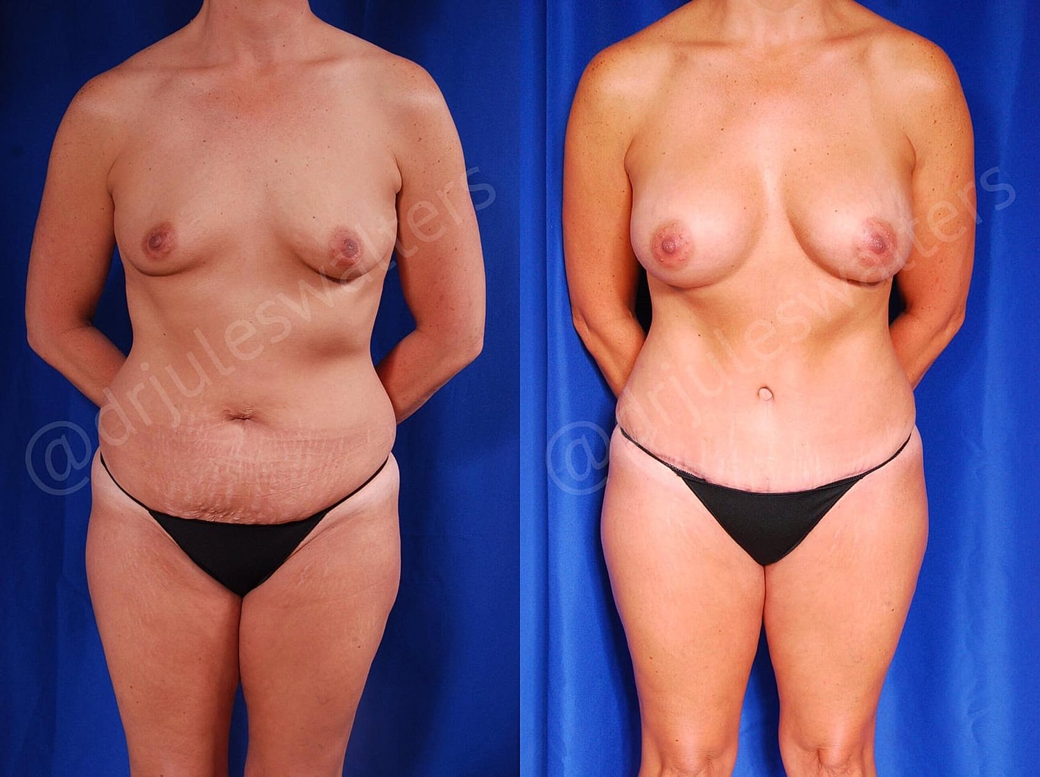 Mommy Makeover Before & After