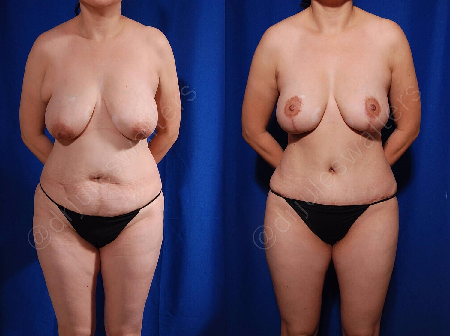 Mommy Makeover Before & After