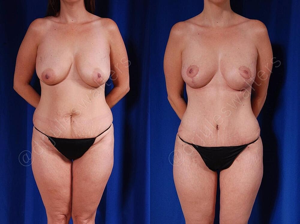 Mommy Makeover Before & After