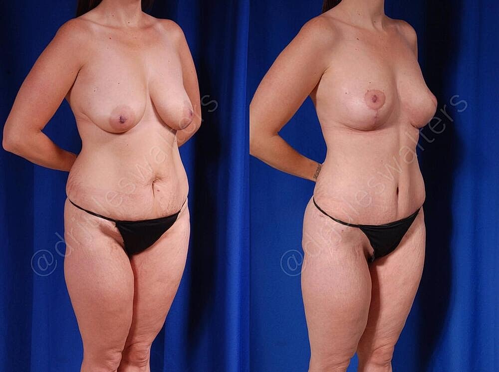 Mommy Makeover Before & After