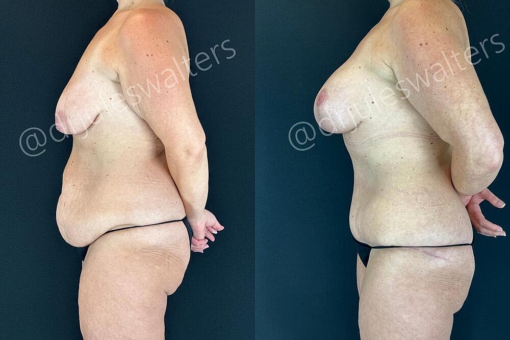 Mommy Makeover Before & After