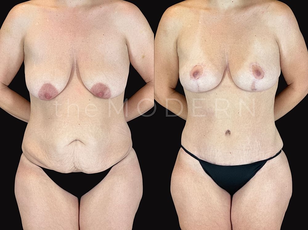 Before and after body transformation showcase.