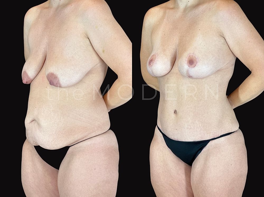 Post-surgery body transformation, side-by-side comparison.