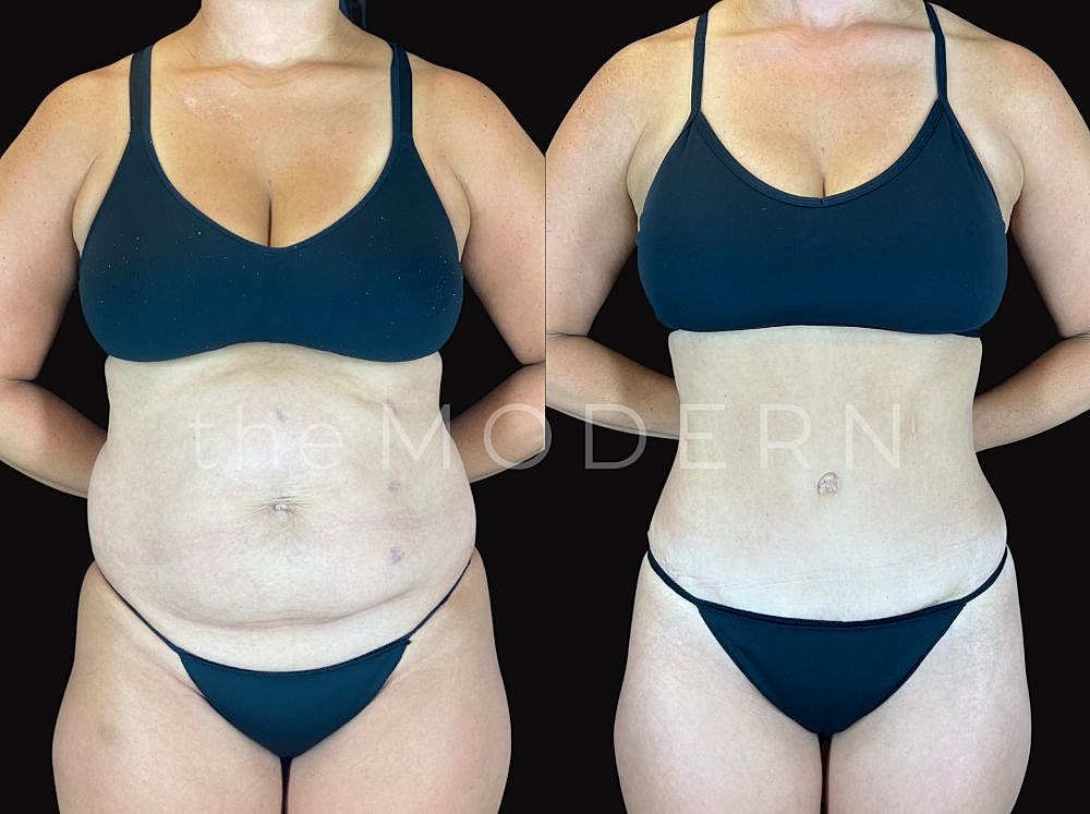 Before and after body transformation comparison.