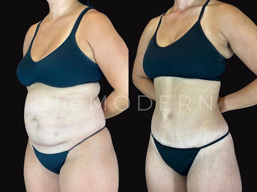 Before and after body transformation comparison image.