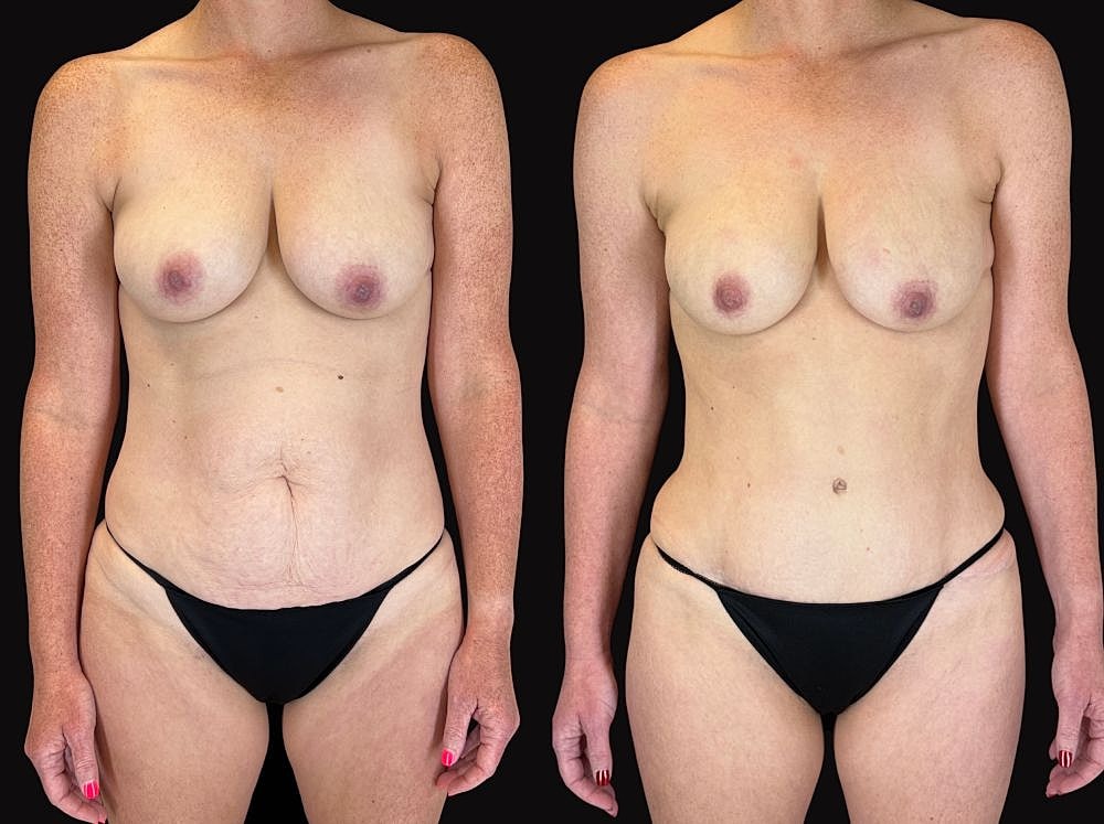 Before and after body transformation comparison.