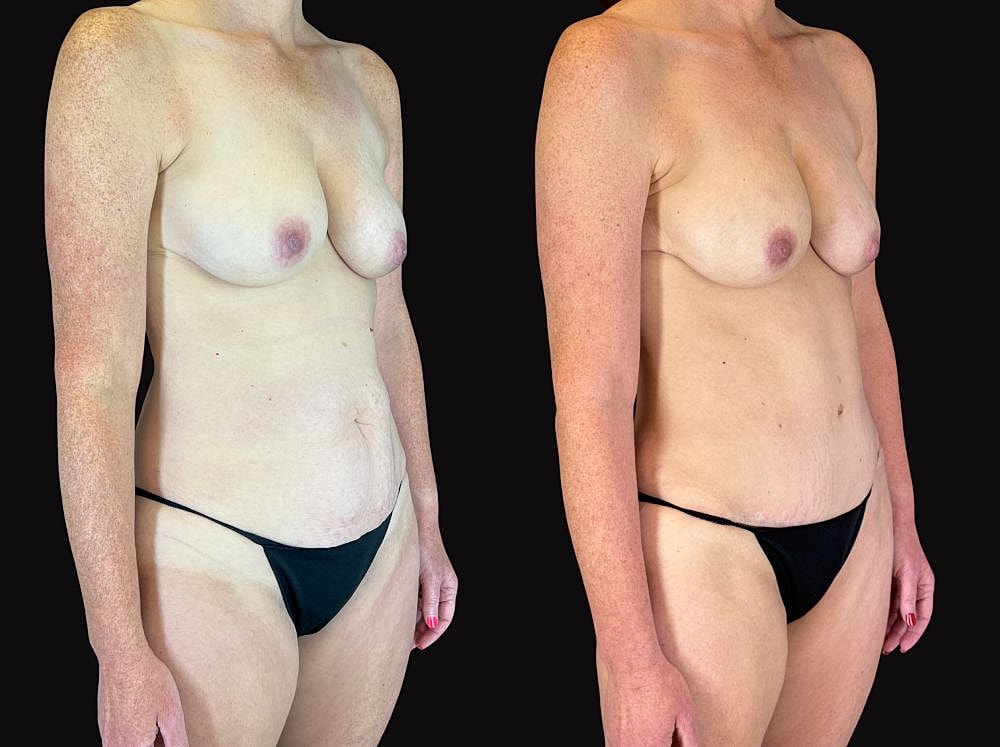 Comparison of skin tones on a woman's body.