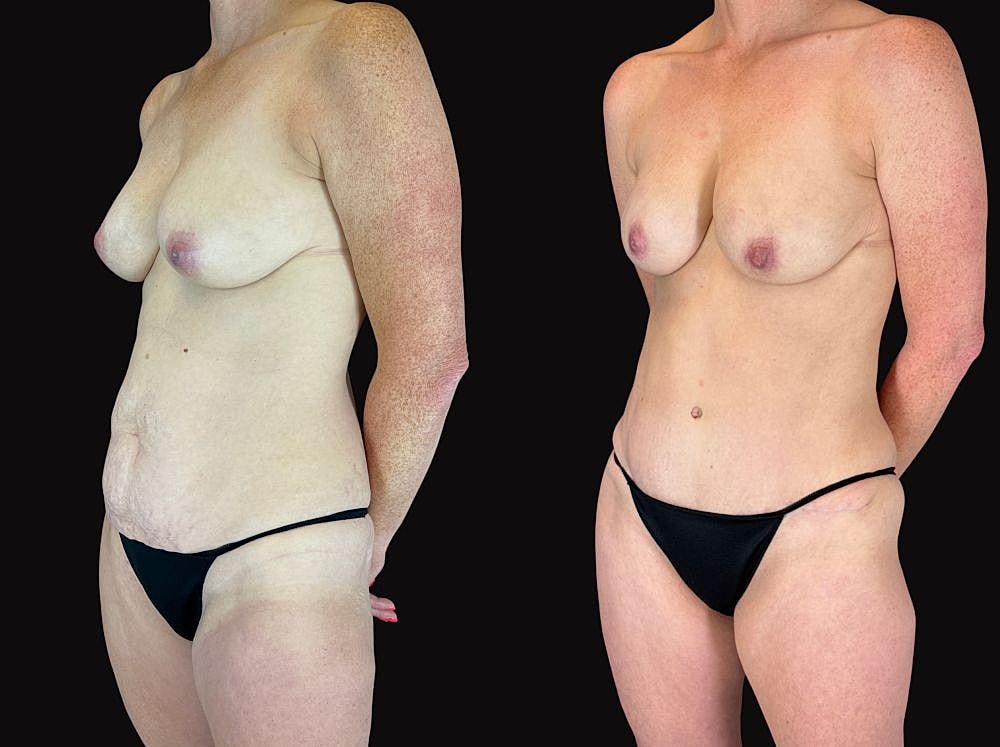 Before and after body contouring transformation.