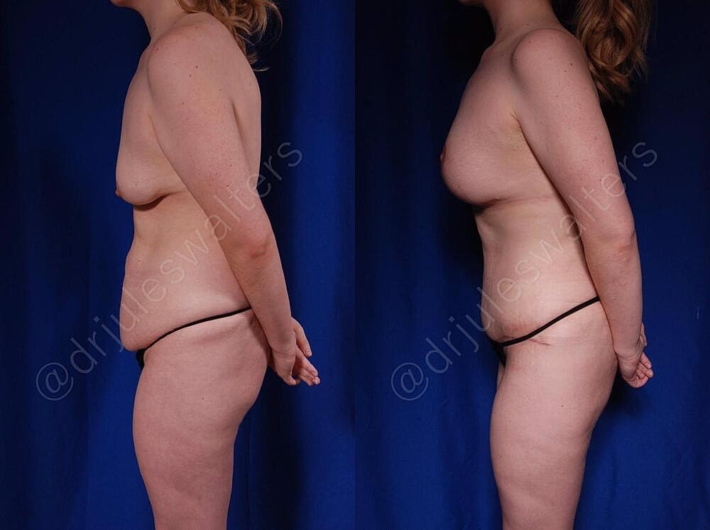 Mommy Makeover Before & After