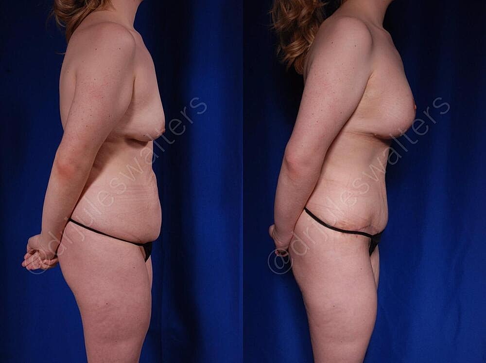 Mommy Makeover Before & After