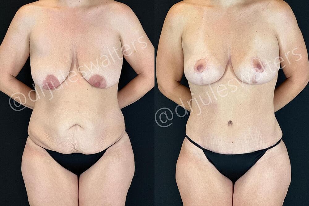 Mommy Makeover Before & After