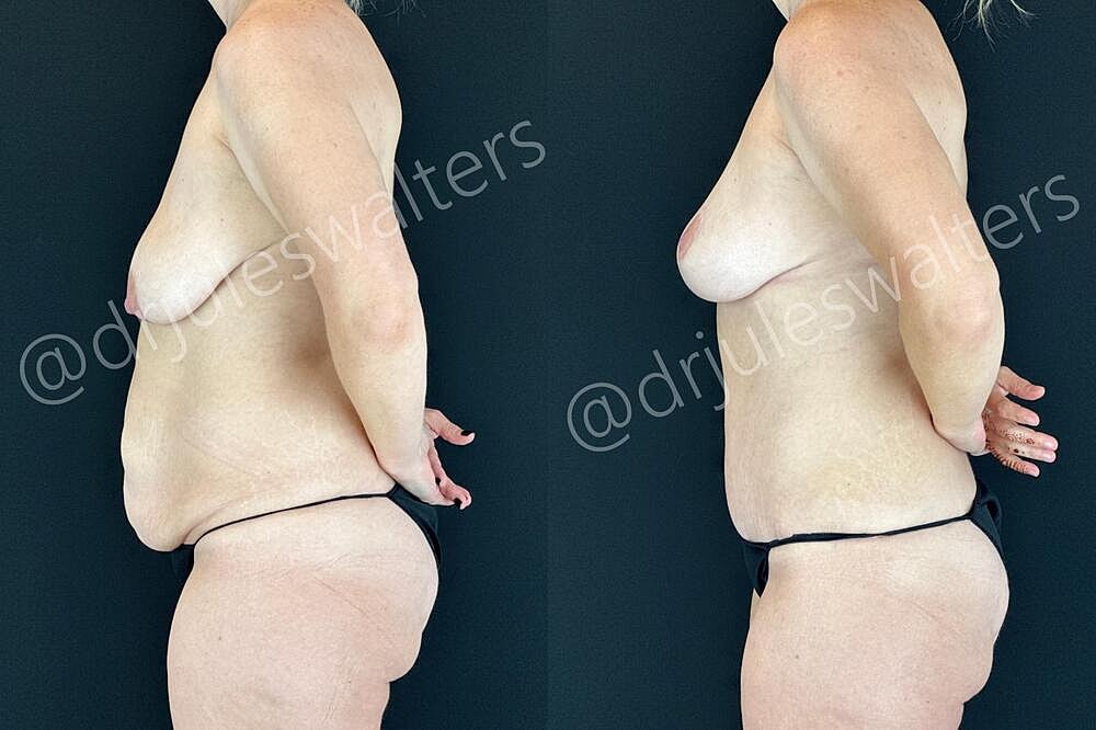 Mommy Makeover Before & After