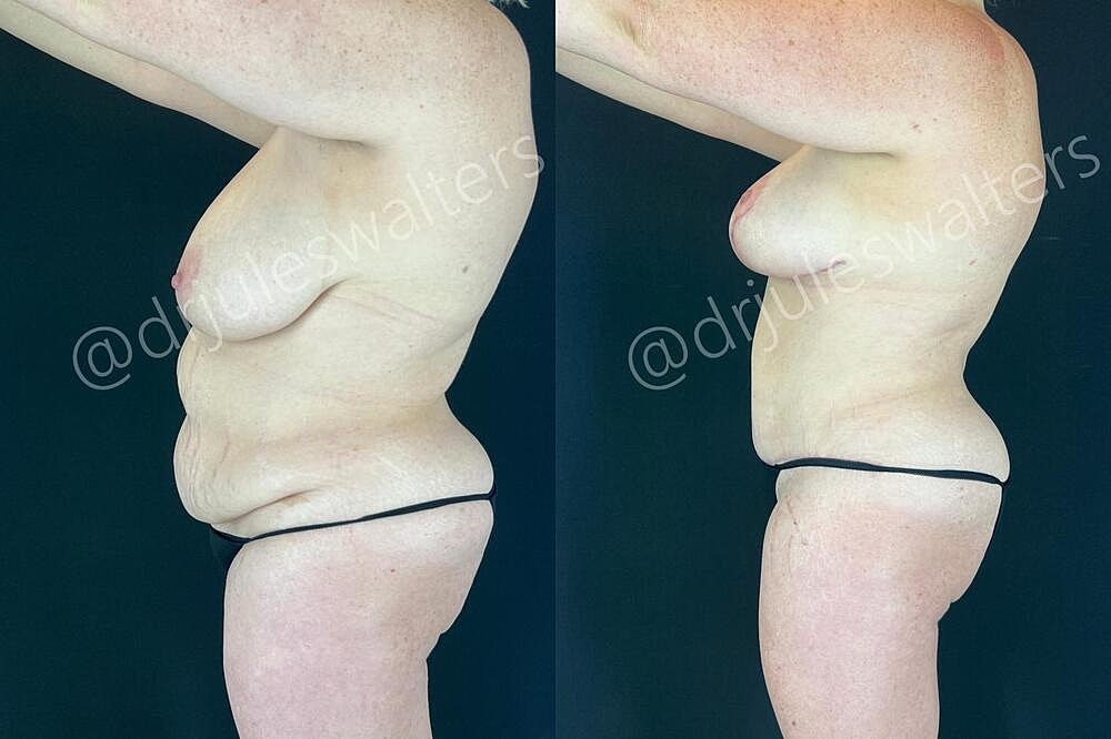 Mommy Makeover Before & After