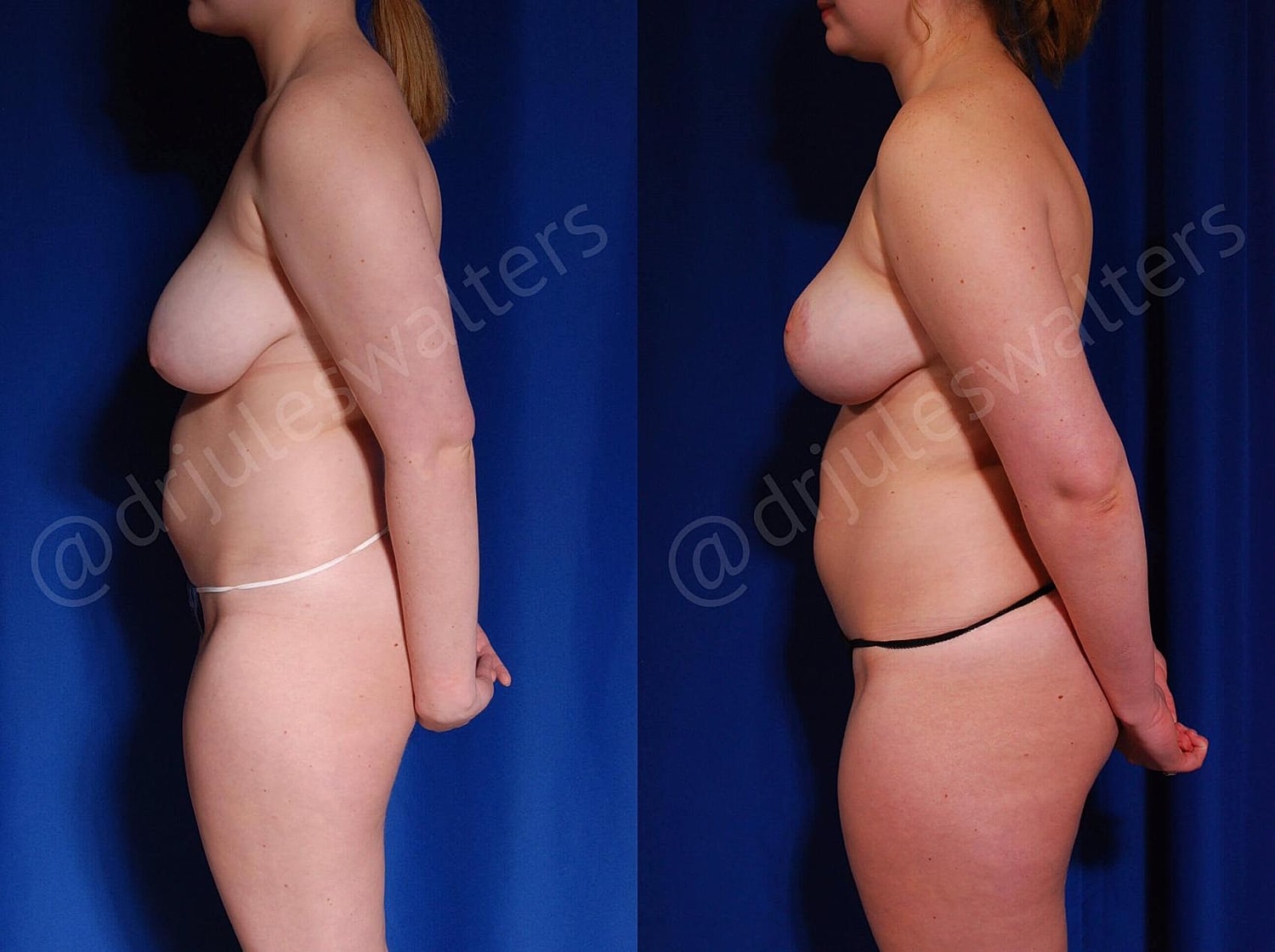Breast Reduction Before & After