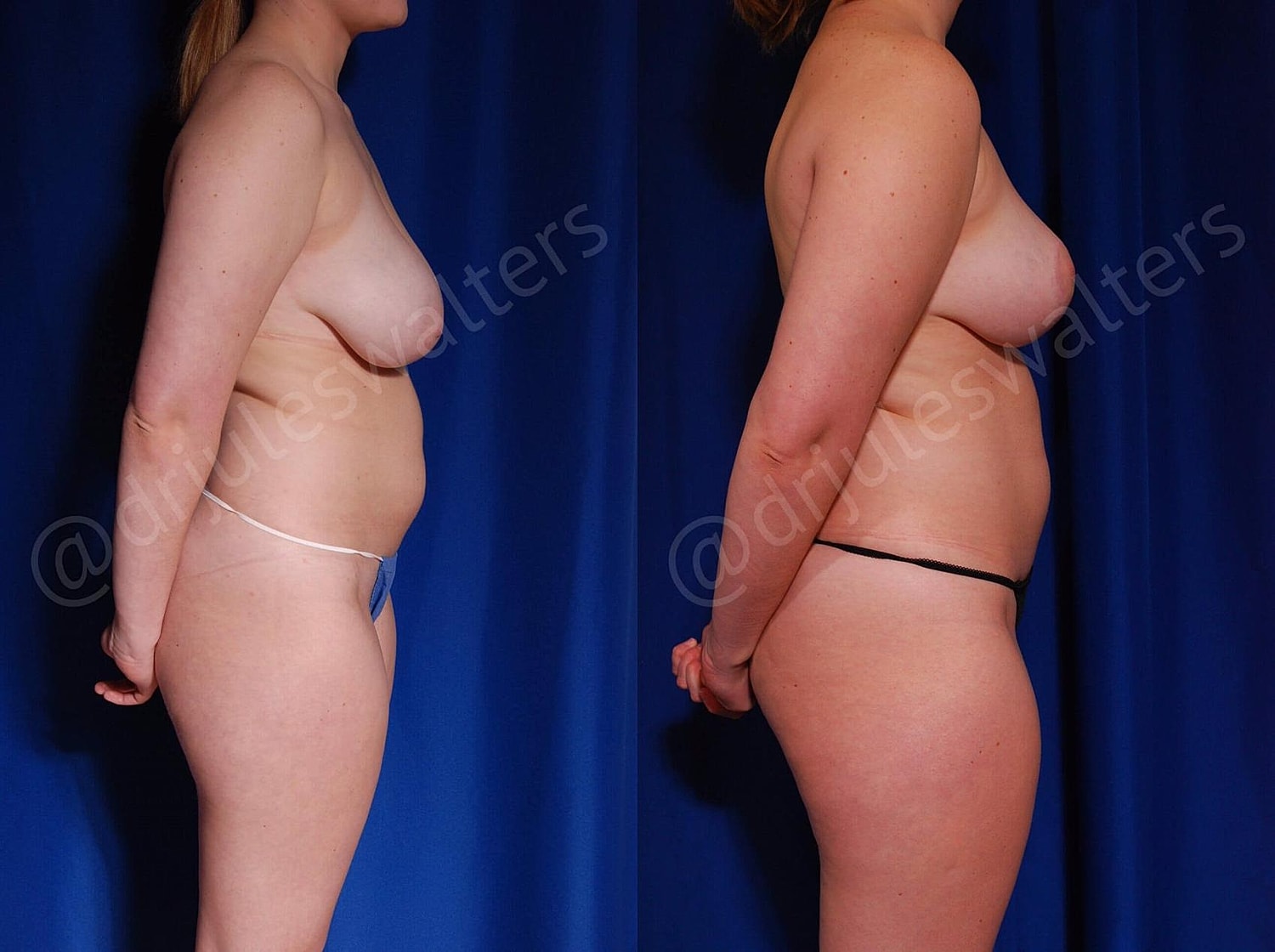 Breast Reduction Before & After