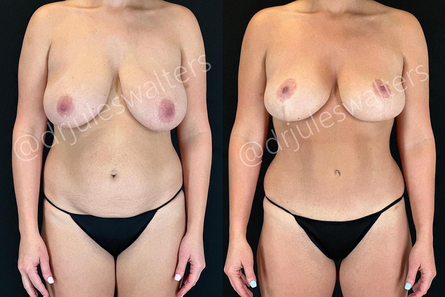 Breast Reduction Before & After