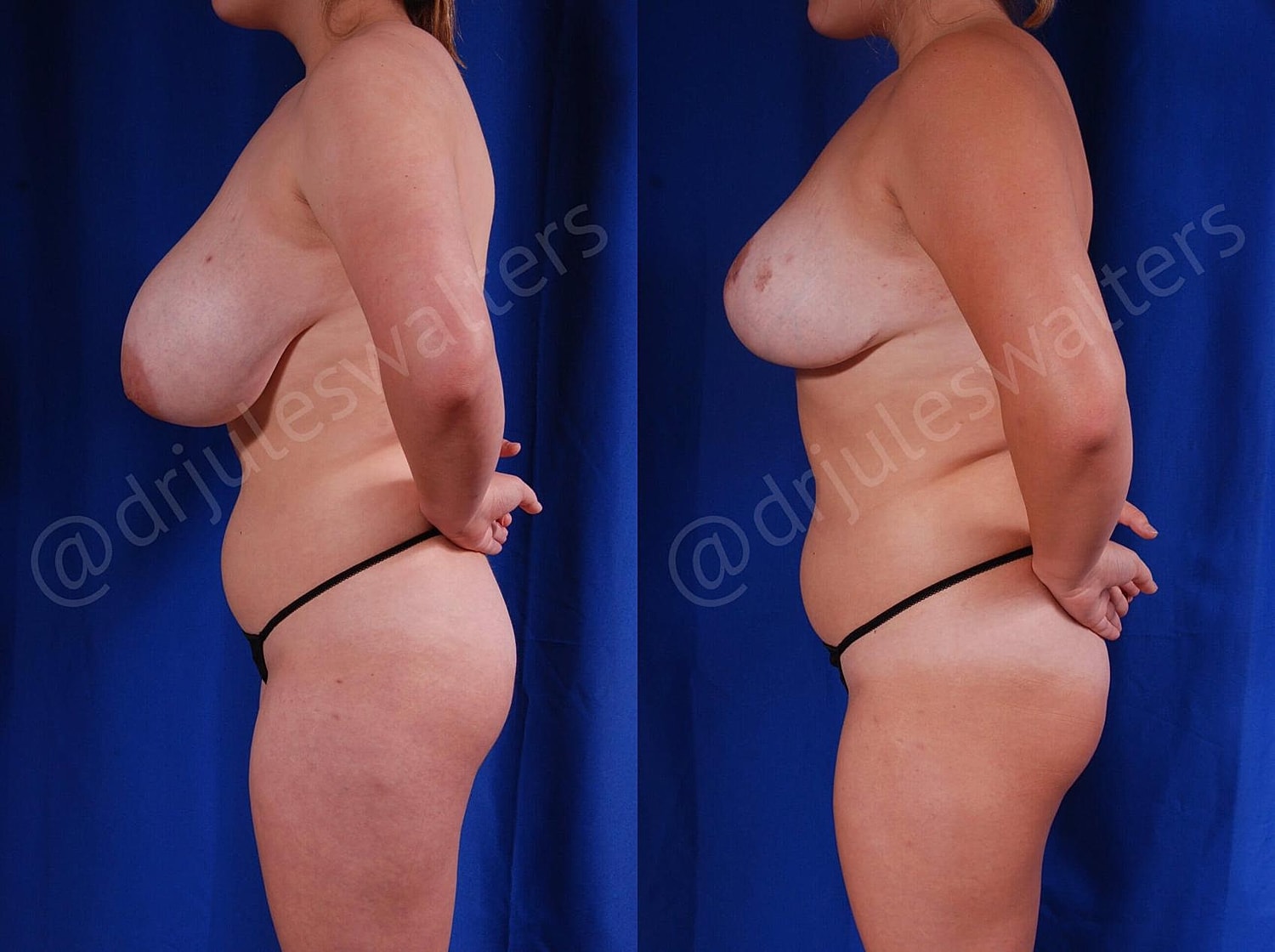 Breast Reduction Before & After