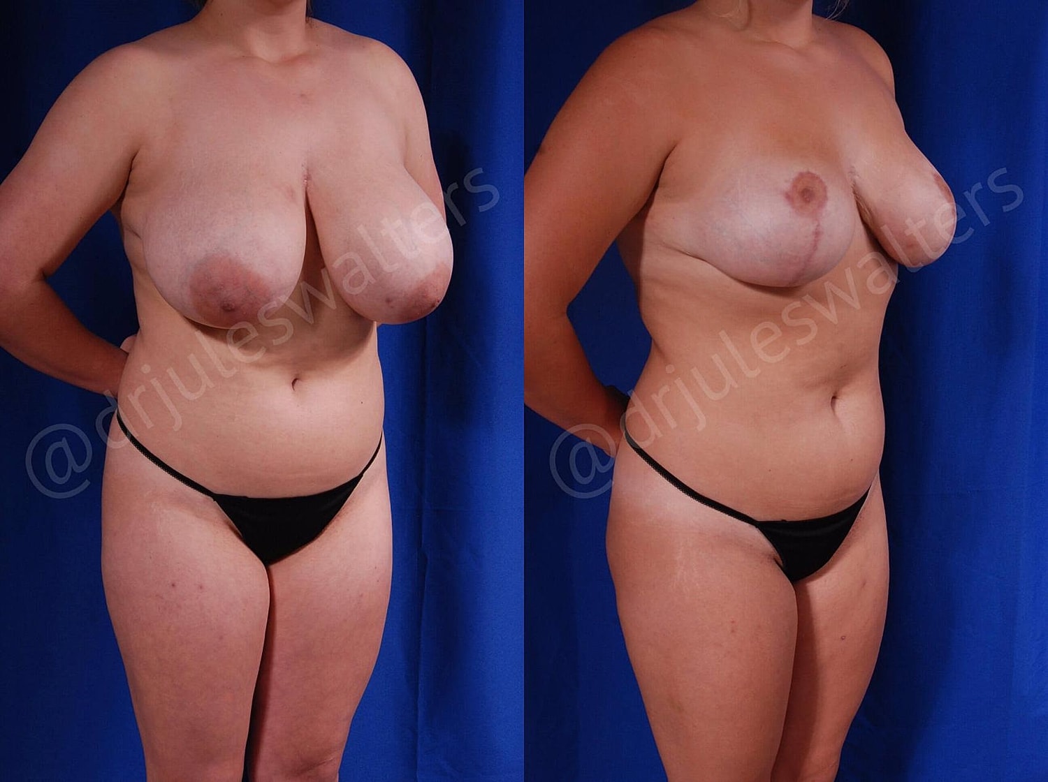 Breast Reduction Before & After