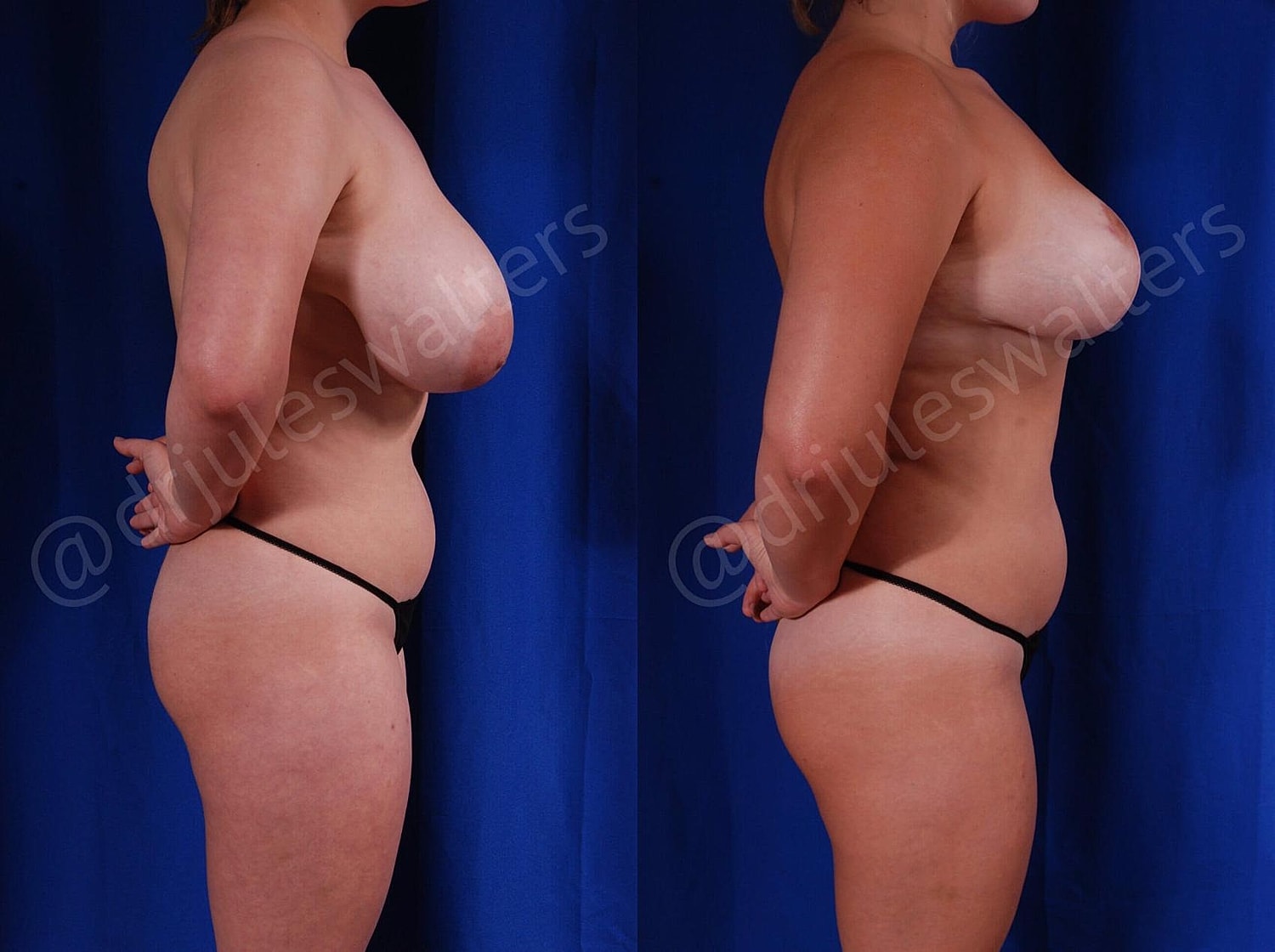 Breast Reduction Before & After