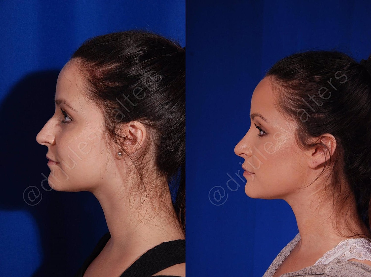 Rhinoplasty Before & After