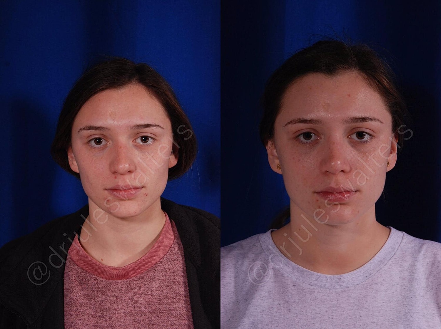 Rhinoplasty Before & After