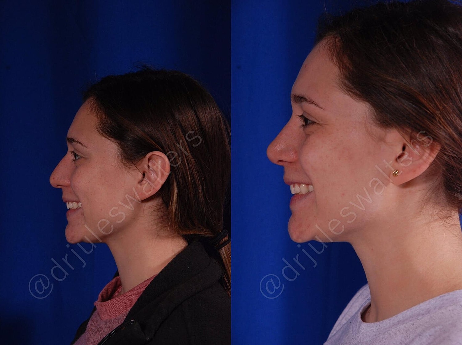 Rhinoplasty Before & After
