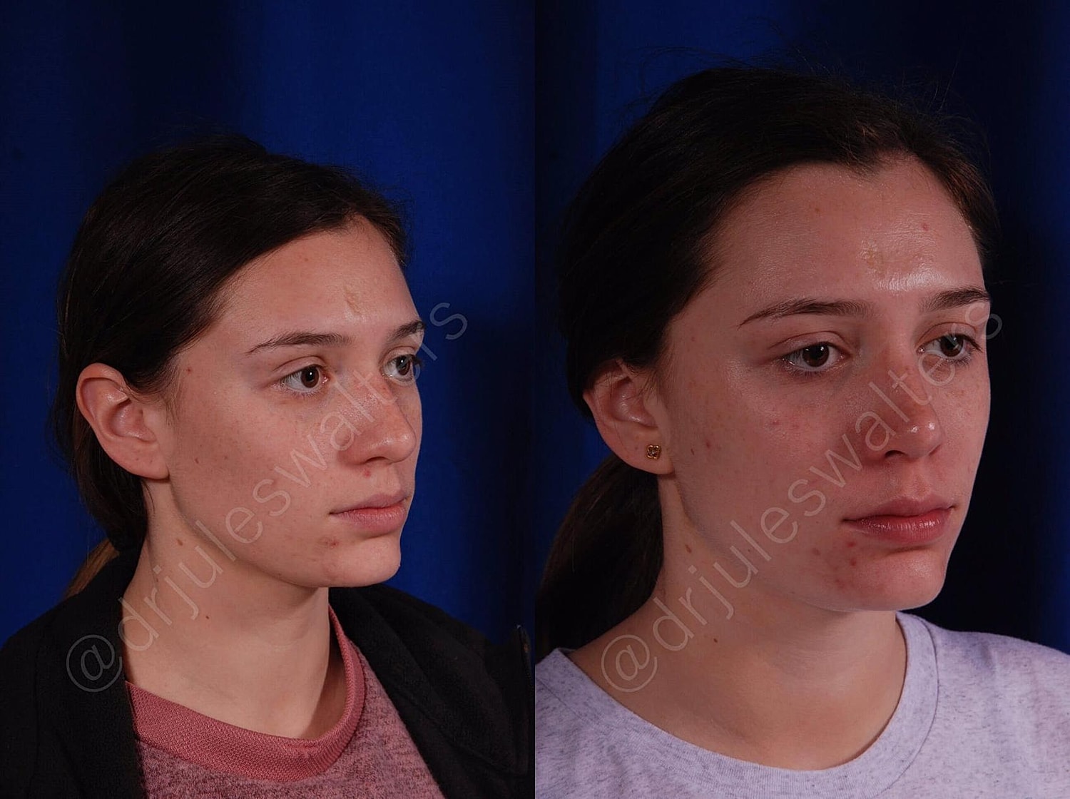 Rhinoplasty Before & After