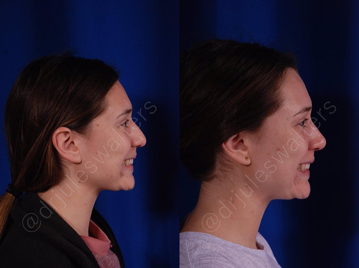 Rhinoplasty Before & After