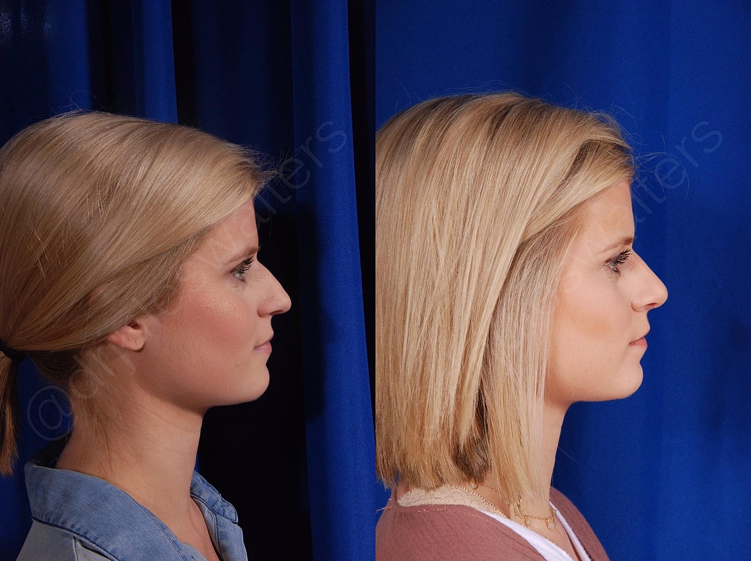 Rhinoplasty Before & After