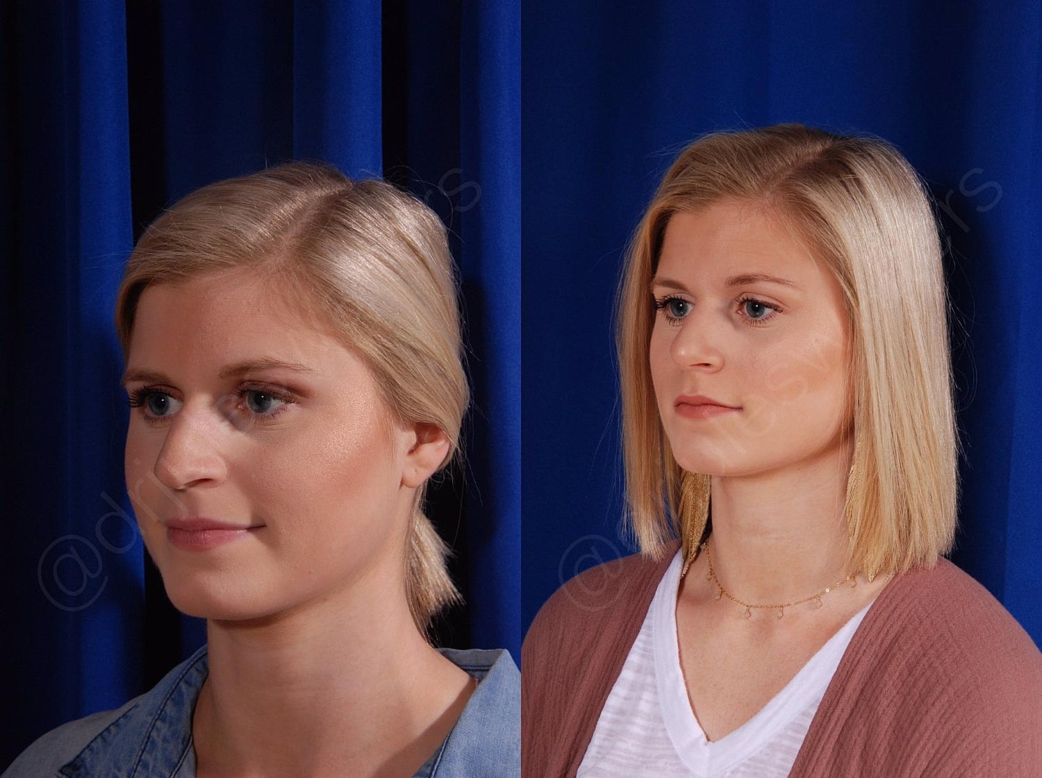 Rhinoplasty Before & After