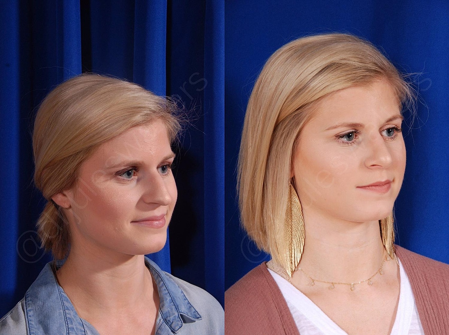 Rhinoplasty Before & After