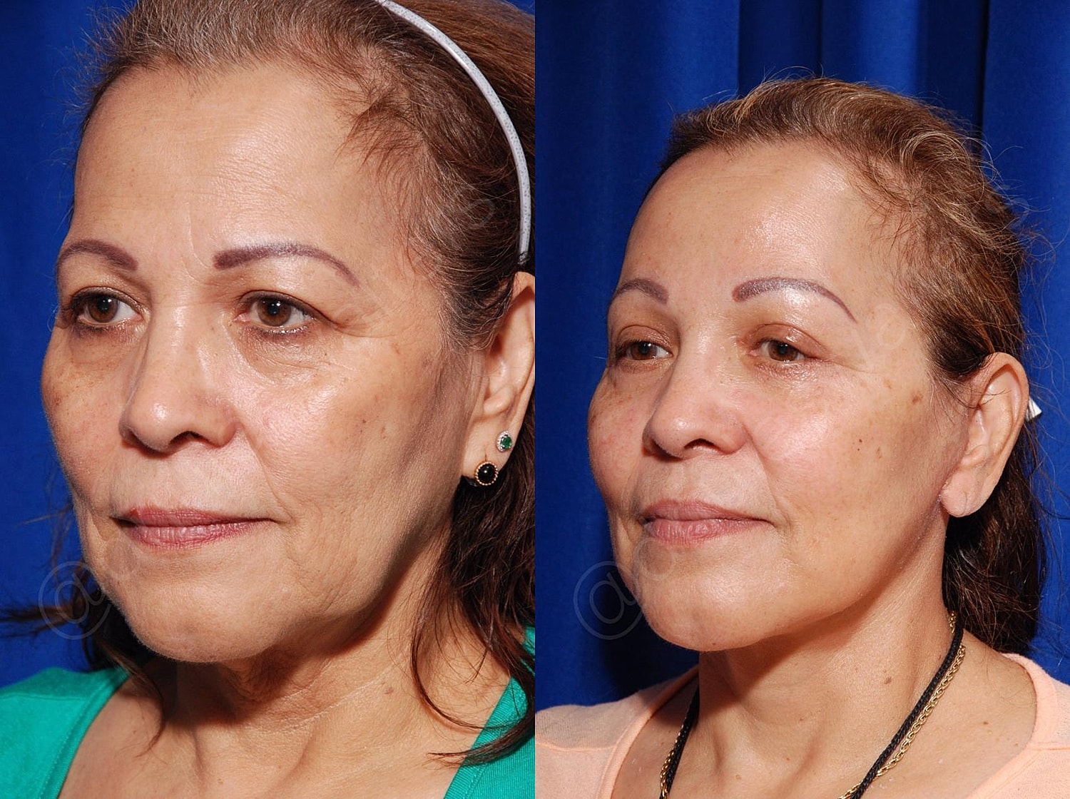Facelift Before & After