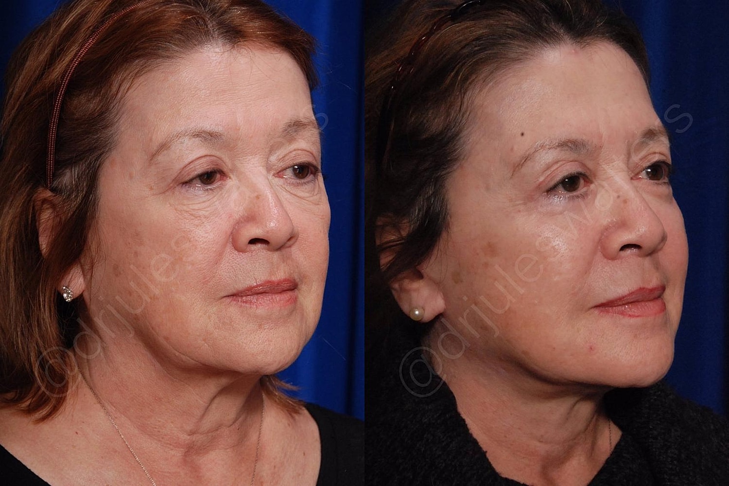 Facelift Before & After