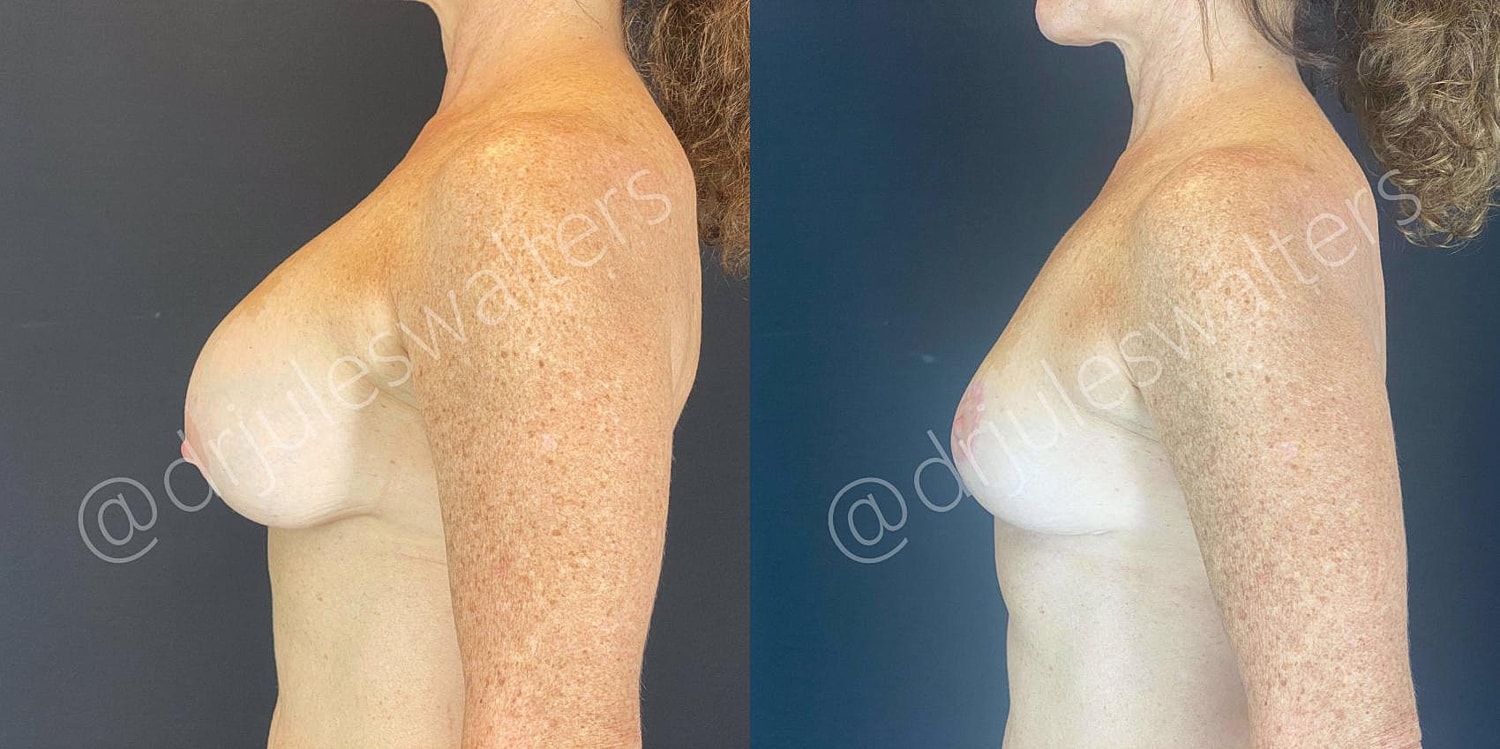 Breast Lift Before & After