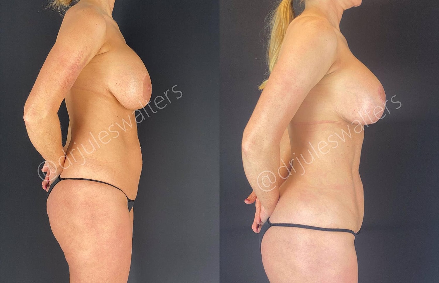 Breast Lift Before & After