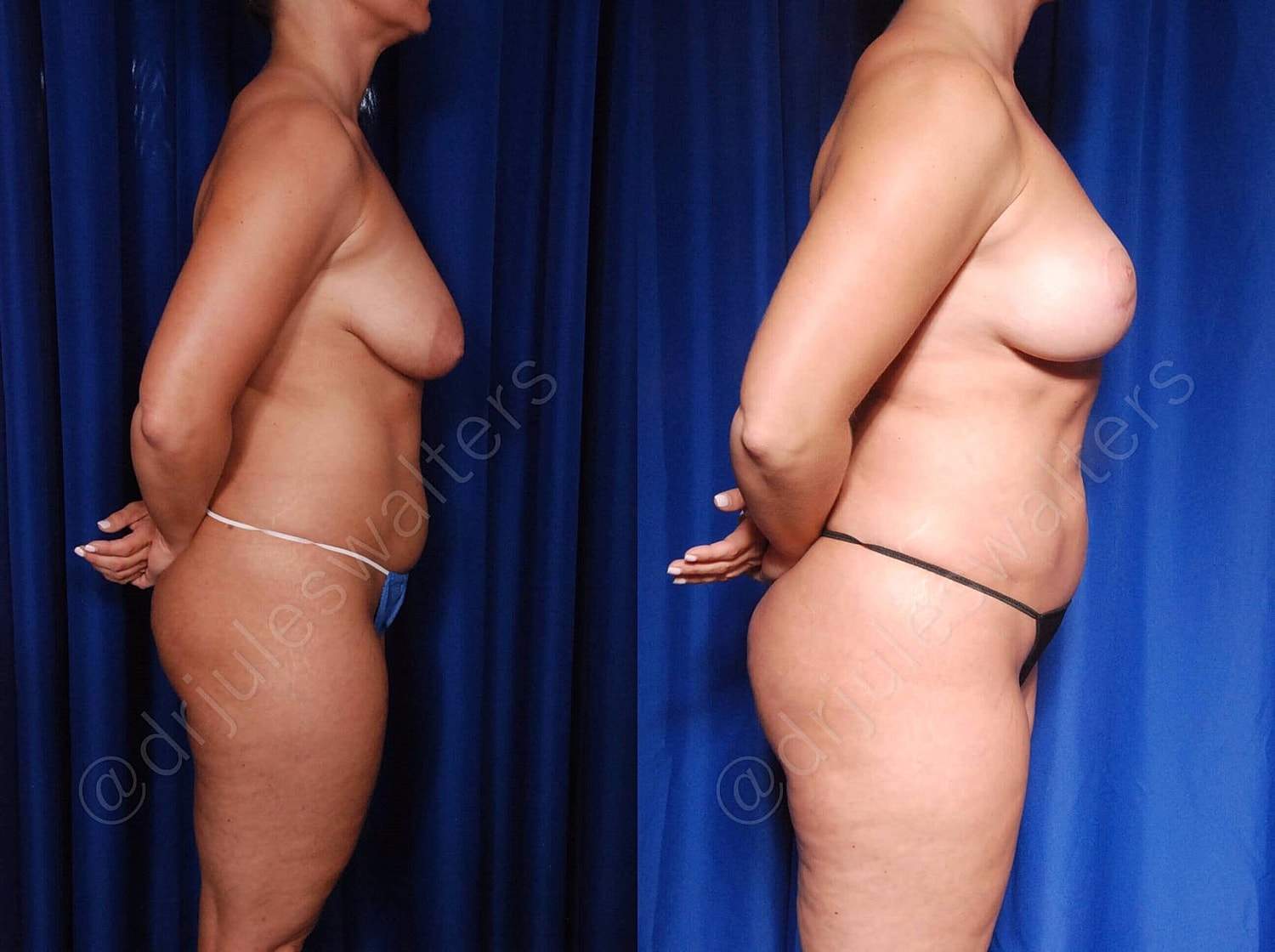 Breast Lift Before & After