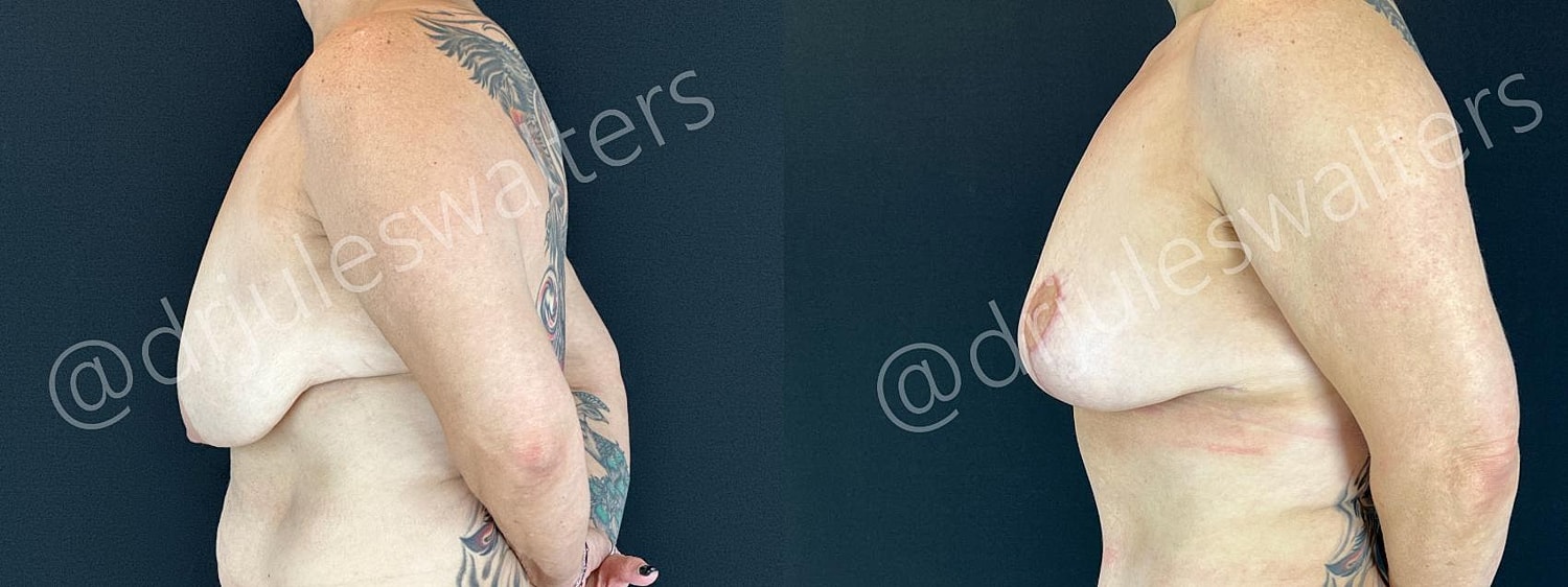 Breast Lift Before & After