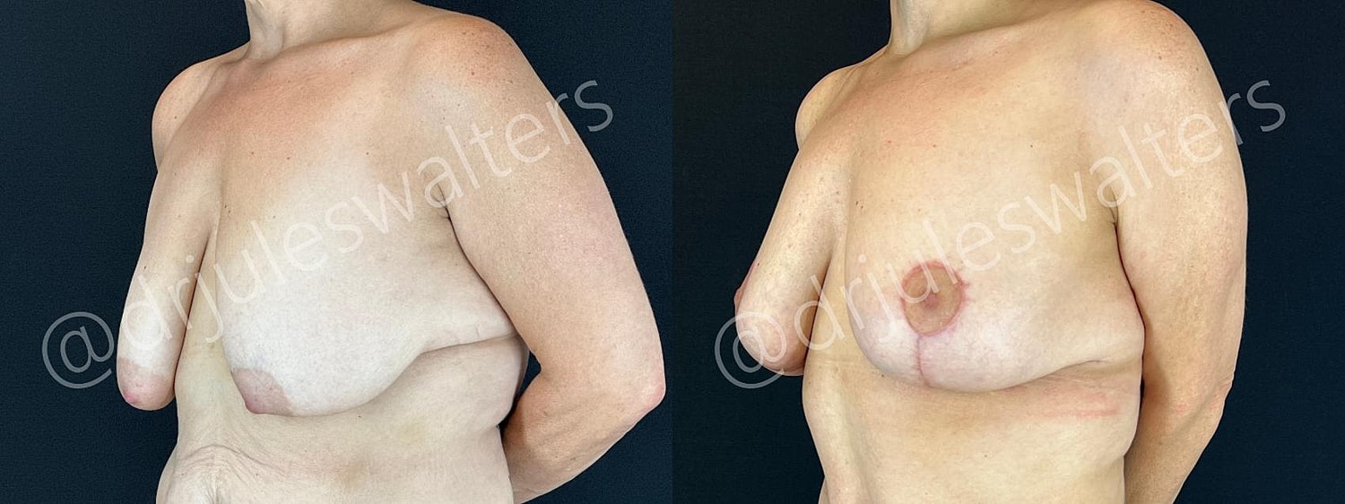 Breast Lift Before & After