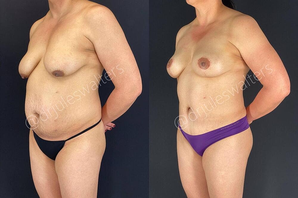 Breast Lift Before & After