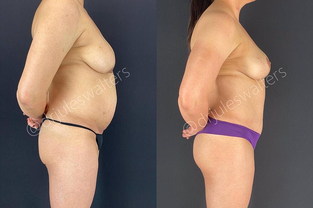 Breast Lift Before & After