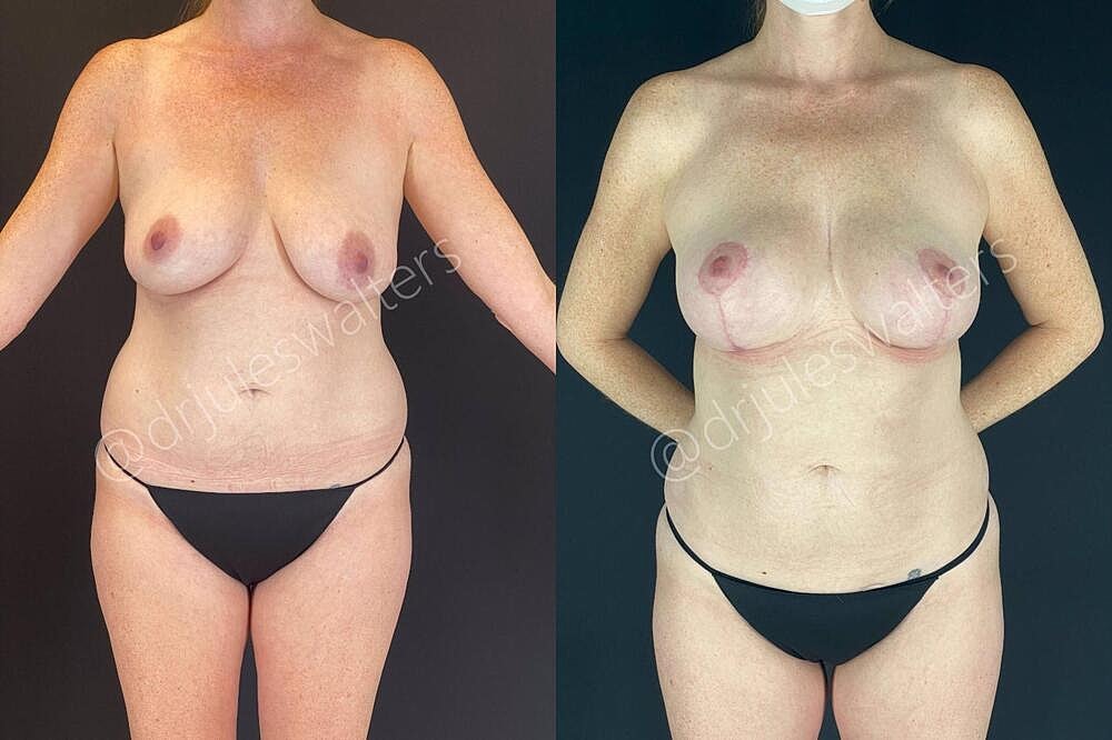 Breast Lift Before & After