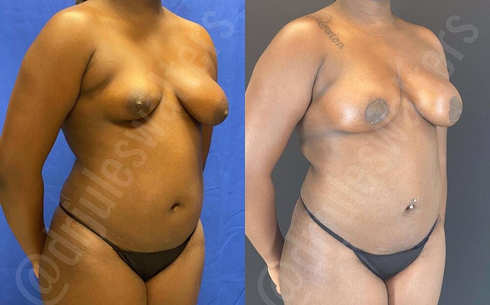 Breast Lift Before & After